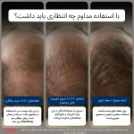 محلول رشد مجدد مو ماینوکسیدیل ۵٪ کرکلند برای آقایان | Kirkland Signature Minoxidil 5% Topical Solution for Men - تصویر 5
